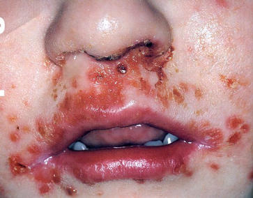 Impetigo of the skin around the mouth