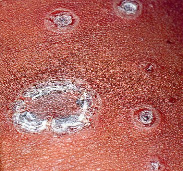Ringworm of the skin