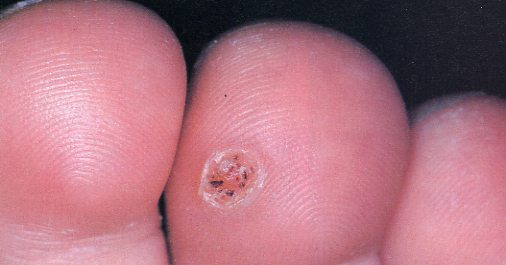 verruca of the foot