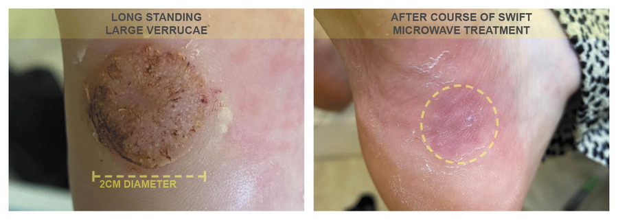 before and after swift treatment of verruca