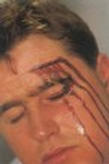facial injury