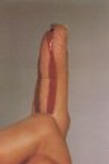 lifted fingernail
