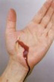 palm wound