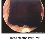 Image of the new channel three months after PVP