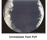 Image of channel created immediately after PVP