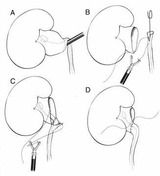Illustration of the surgical technique in correcting the obstructed kidney