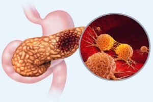 pancreatic cancer detection