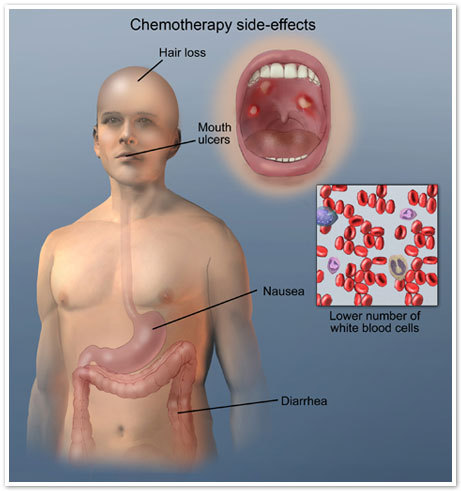 Chemotherapy brain changes irreversable